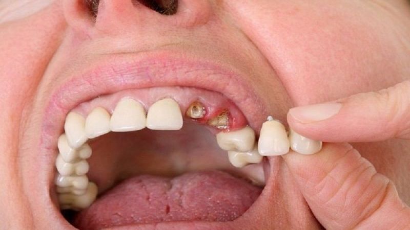 Pasted 87 Chốt số đề cực chuẩn với giấc mơ thấy rụng răng